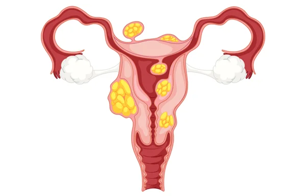 Fibroid Treatment